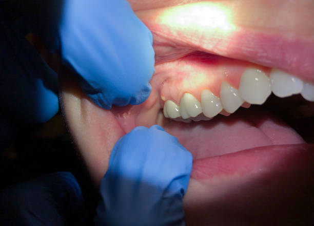 Best Emergency Dentist for Lost Fillings or Crowns in Farmingdale, NY